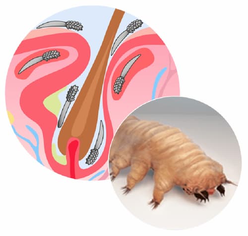 Demodex sống trong lỗ chân lông và tuyến bã nhờn