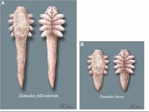 Demodex là gì? Nguyên nhân, dấu hiệu và cách điều trị hiệu quả 2 Demodex folliculorum và demodex brevis là 2 loại ký sinh trùng demodex thường gặp.