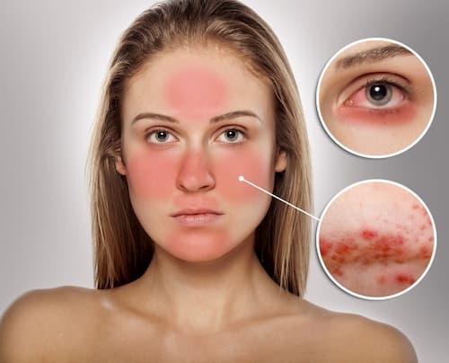 Demodex là gì? Nguyên nhân, dấu hiệu và cách điều trị hiệu quả 6 Cách điều trị viêm da demodex triệt để nhất là chữa từ chính nguyên nhân gây nên demodex