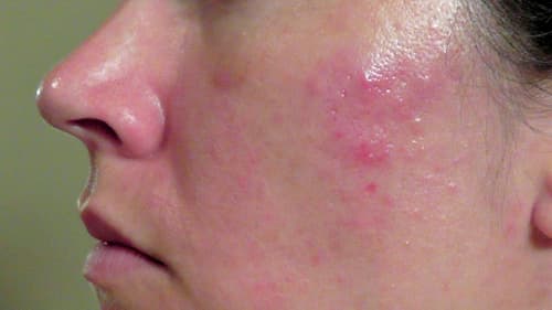 Tất tần tật về Demodex triệu chứng và cách điều trị, xét nghiệm Demodex ở đâu? 4 Mẩn đỏ và cảm giác ngứa châm chích là dấu hiệu cụ thể nhất của demodex