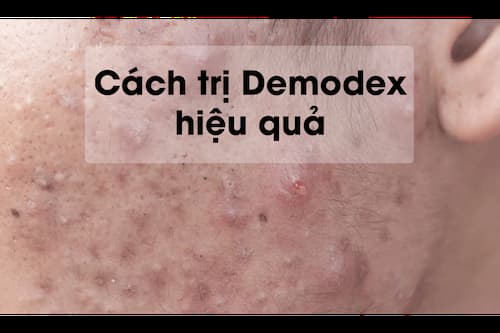 Ve Demodex - Sát Thủ Thầm Lặng Của Làn Da 2 Khi bị nhiễm Demodex thì cơ hội cho mụn mủ, mụn bọc, mụn trứng cá,... làm "ổ"