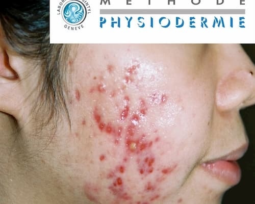 Corticoid tác dụng phụ và cách khắc phục 4 Corticoid tác dụng phụ gây ra viêm da demodex