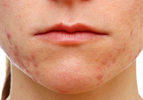 Demodex gây mụn! Dấu hiệu da bị nhiễm Demodex & Mẹo điều trị 1 Dấu hiệu da bị nhiễm demodex