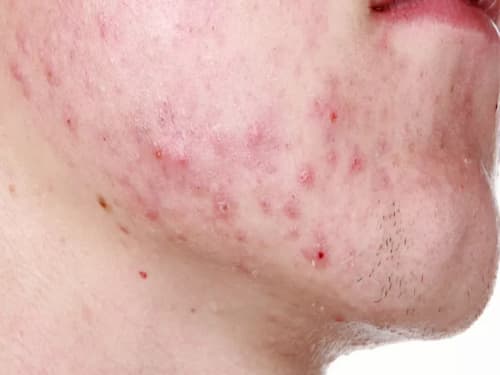Demodex sinh sôi và phát triển mạnh trên một vùng da nhất định sẽ gây tổn thương da nghiêm trọng