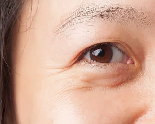 Bọng mắt sưng: Cách loại bỏ triệt để bọng mắt và quầng thâm 1 Bọng mắt ngày nay không chỉ phổ biến ở người trung niên mà còn phổ biến ở người trẻ