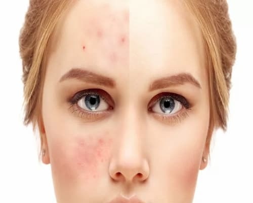Có Nên Tẩy Tế Bào Chết Cho Da Mụn Không? 1 Da mụn là 1 loại da nhạy cảm