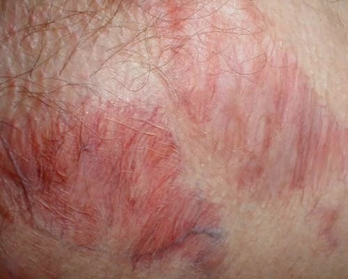 Corticoid là gì? Corticoid thực sự có tác hại gì đối với sức khỏe? 2 Sau thời gian sử dụng sẽ làm cho da giãn tĩnh mạch, mạch máu nổi lên bề mặt da
