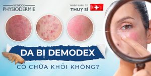 demodex có chữa khỏi không