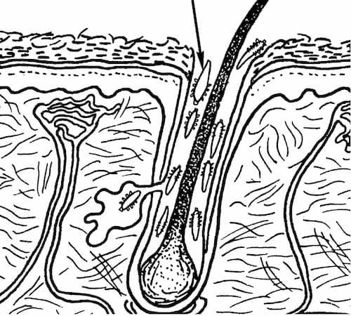 Demodex đang đào hang làm ổ để đẻ trứng trong nang lông/tóc