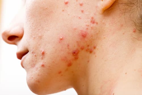 Mặt nạ ngủ Skin Care và 4 Hậu Quả khôn lường khi lạm dụng 3 Mụn có thể xuất hiện khi da tiết quá nhiều dầu và bít tắc lỗ chân lông