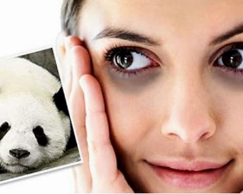 Trị thâm mắt bằng muỗng có thật sự hiệu quả như đồn thổi?