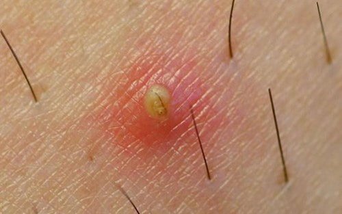 Viêm lỗ chân lông là bệnh gì?