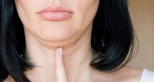 Công dụng tuyệt vời của massage thải độc da qua hệ bạch huyết 5 Nọng cằm - kết quả của ứ đọng dịch trong cơ thể