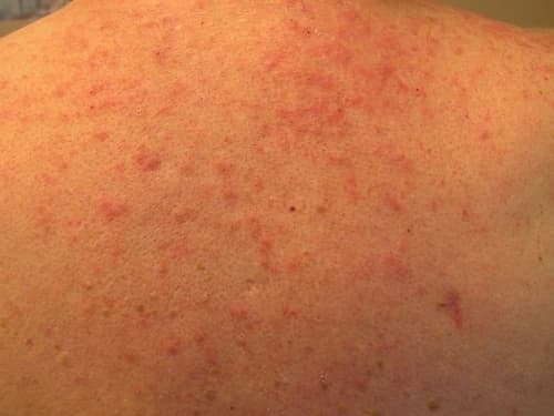 7 Bí mật về Viêm chân lông mà bạn chưa hề biết 1 Viêm lỗ chân lông, viêm nang lông và viêm chân lông có gì khác nhau?