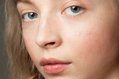 Redness Rescue Bioserum và câu chuyện về làn da nhạy cảm 1 Da nhạy cảm