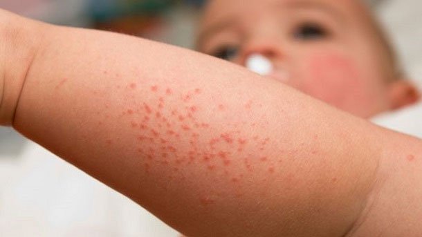 Trẻ em bị viêm chân lông Trẻ em bị viêm chân lông