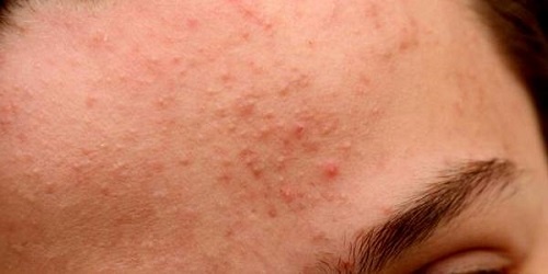 Da mặt bị viêm chân lông khác break-out như thế nào? 2 Da đang trong giai đoạn đẩy mụn do sử dụng treatment