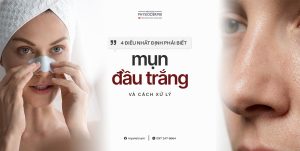 nhận biết mụn đầu trắng và cách xử lý