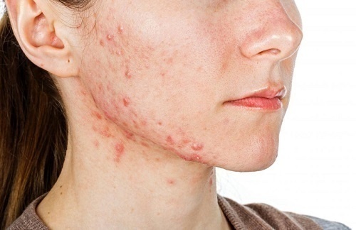 Phân biệt các loại mụn thường gặp: Hiểu đúng để trị đúng! 6 Mụn trứng cá