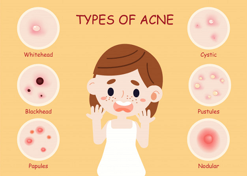 Mụn đầu đen và những điều chưa biết! 1 Phân biệt mụn đầu đen và các loại mụn khác