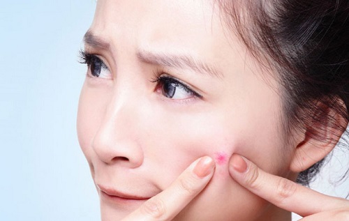 Mụn sần: Nguyên nhân và Cách xử lý 3 Không tự ý nặn mụn