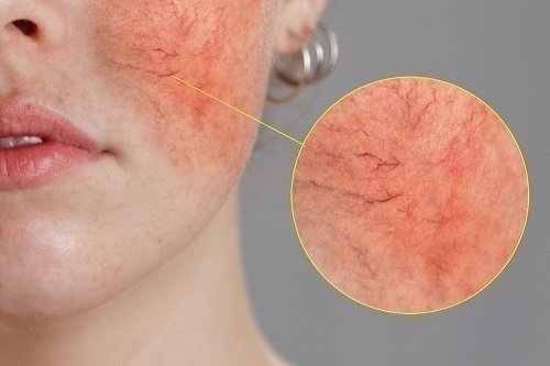 Chứng đỏ mặt (Rosacea) và Những nguy hiểm tiềm ẩn 3 Giai đoạn 2 - Da ửng đỏ liên tục, lộ mao mạch