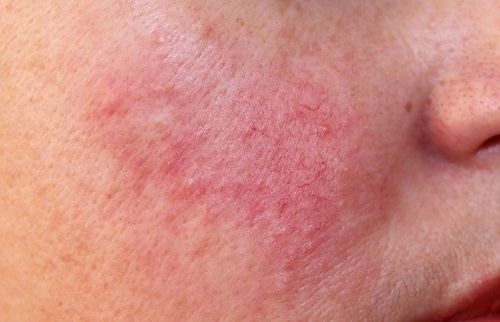 Chứng đỏ mặt (Rosacea) và Những nguy hiểm tiềm ẩn 4 Giai đoạn 3 - Mụn đỏ và mụn mủ kéo dài