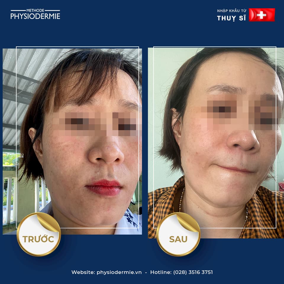 Liệu trình số 13: ĐIỀU TRỊ NÁM VÀ LÀM SÁNG DA 2 Chị T (40T) – Điều trị nám, xạm da chỉ trong 2 tháng sử dụng sản phẩm