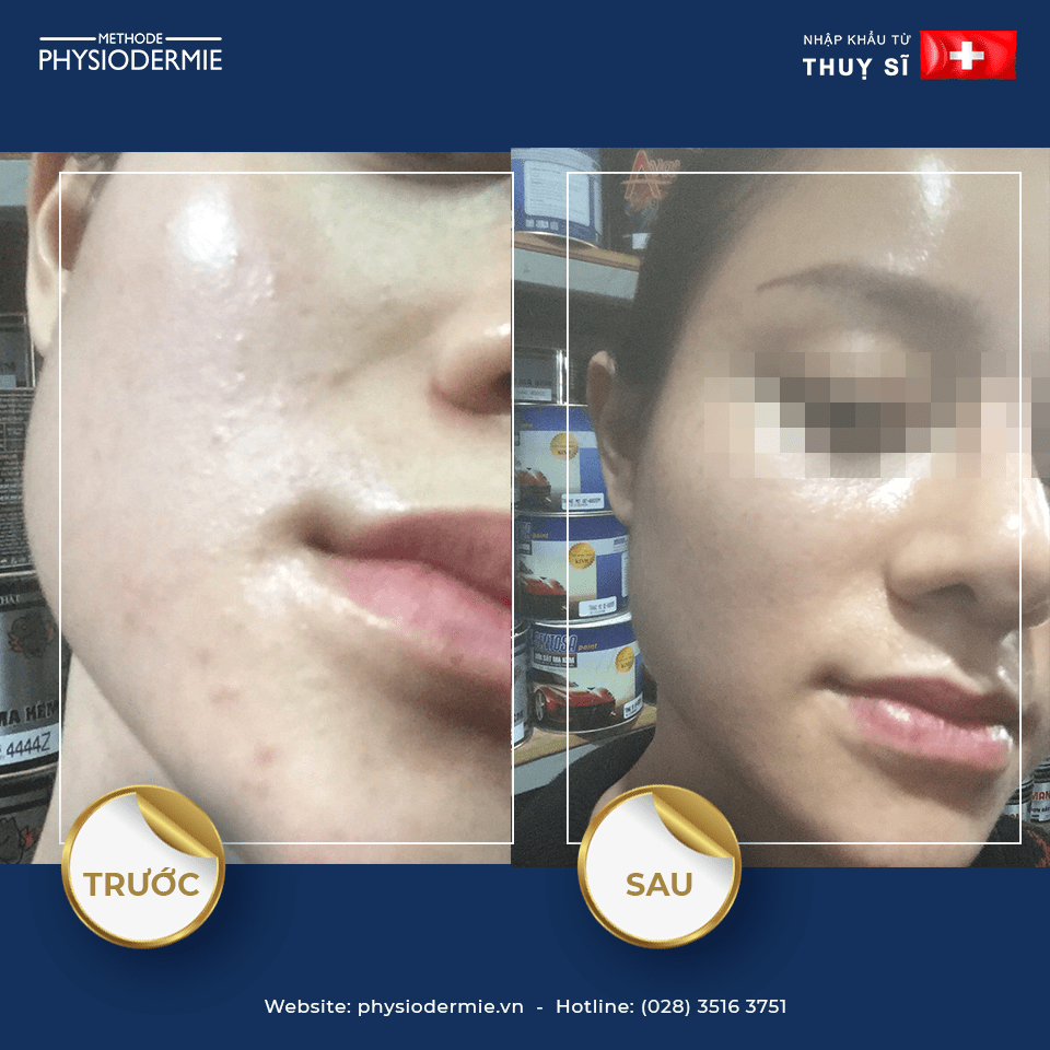 Liệu trình số 2: ĐIỀU TRỊ MỤN TRỨNG CÁ (ĐẦU ĐEN, ĐẦU TRẮNG) 2 Chị Q – Điều trị mụn đầu trắng, mụn ẩn dưới da chỉ trong 1 tháng