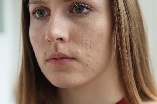 Da sưng đỏ rát có phải là biểu hiện của Rosacea? 1 Mụn ồ ạt xuất hiện báo hiệu các bệnh về da