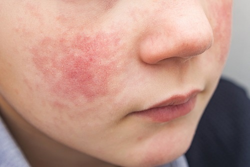 Bệnh đỏ mặt thường xuyên là biểu hiện của Rosacea hay chàm Eczema? 3 Bệnh chàm có khả năng di truyền giữa những người có cùng huyết thống
