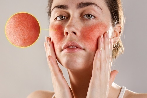 Bệnh Đỏ Da Mặt Là Bệnh Gì? 1 Bệnh đỏ da mặt thường xuất hiện ở lứa tuổi 30 đến 50, nữ nhiều hơn ở nam