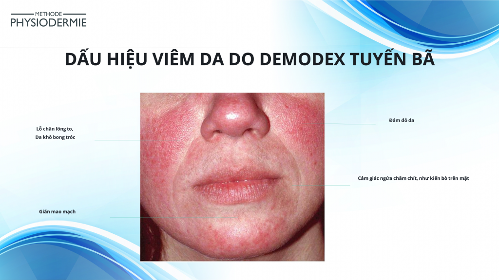 Tai biến da do Demodex - Điều trị & dự phòng tái phát 3 Dấu hiệu viêm da do demodex tuyến bã