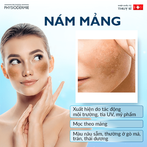 tang-sac-to-da2 Nám mảng - Một dạng tăng sắc tố da mặt