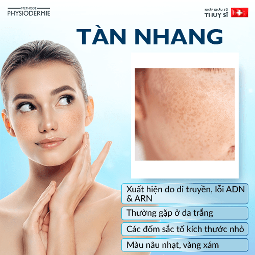 Các loại tăng sắc tố da lành tính vùng mặt 4 Tàn nhang