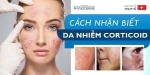 cách nhận biết da nhiễm corticoid