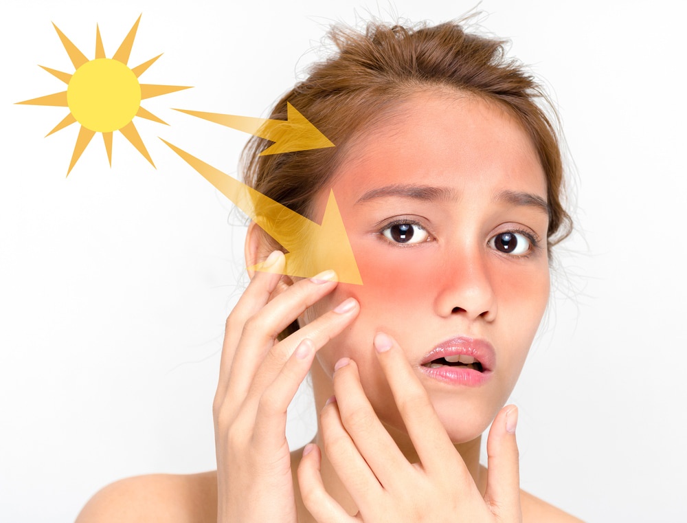 Giãn Mao Mạch Có Phải Dấu Hiệu Da Mặt Nhiễm Corticoid? 3 Da bị ảnh hưởng bởi tia UV
