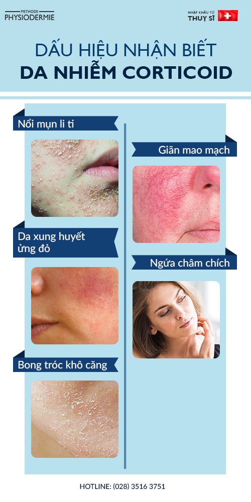 Da nhiễm corticoid - Nguyên nhân & dấu hiệu nhận biết 2 Các dấu hiệu nhận biết da bị nhiễm corticoid