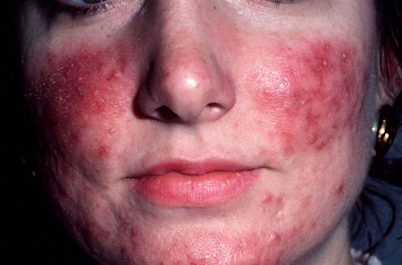 Da nhiễm corticoid - Nguyên nhân & dấu hiệu nhận biết 3 Dấu hiệu da tổn thương nặng do corticoid