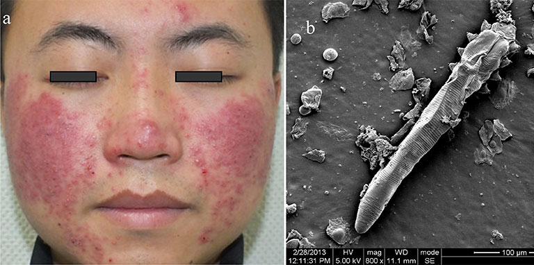 So sánh biểu hiện của da nhiễm Corticoid và viêm da Demodex 3 Bệnh viêm da do Demodex