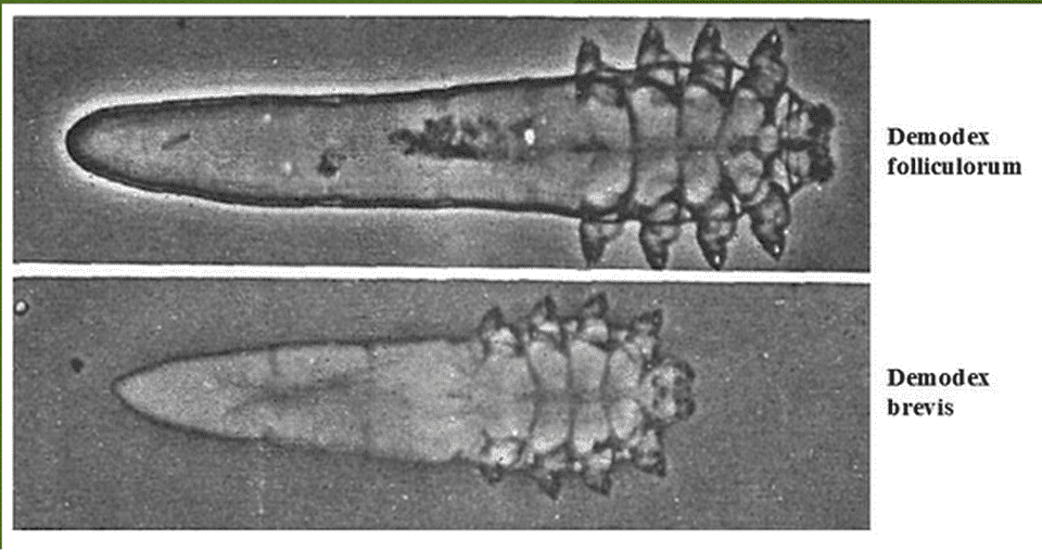 Giải mã Bệnh Demodex là bệnh gì? 1 Demodex folliculorum và Demodex brevis