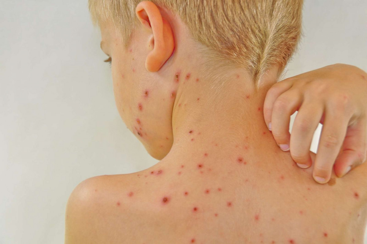 7 Thuốc có thành phần Corticoid thông dụng nhất 2 Bệnh lupus ban đỏ