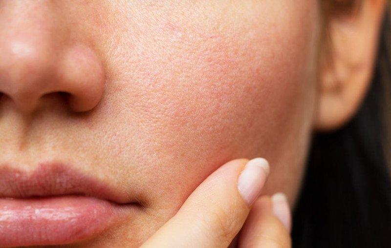 Ceramide phu hop da kho nguyên nhân khiến da trở nên nhạy cảm