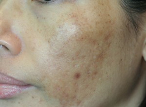Tình trạng tăng sắc tố da sau laser bị tác động bởi 2 phía: người điều trị và người tiếp nhận điều trị.