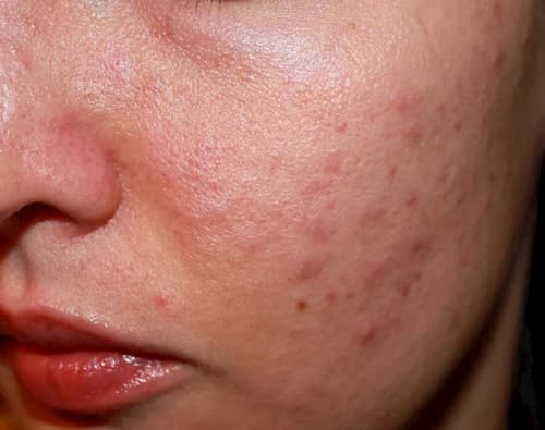 Người có cơ địa da dầu thường có khả năng cao bị nhiễm demodex