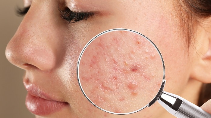 Ký sinh trùng Demodex gây ra các tổn thương trên da như mụn, mẩn đỏ