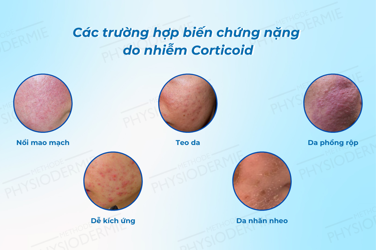 Các trường hợp biến chứng cấp độ nặng do nhiễm corticoid
