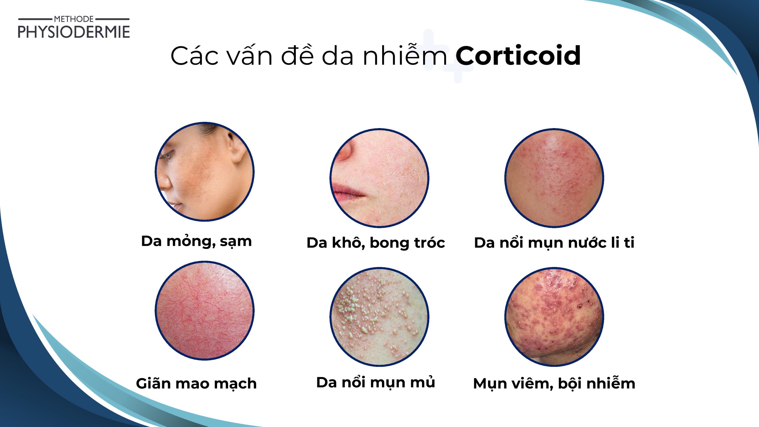 Da bị nhiễm Corticoid do sử dụng không đúng cách sẽ gây tổn thương hàng rào bảo vệ da tự nhiên, biểu hiện có thể nhìn thấy như da khô, nổi mụn,...