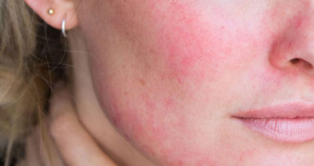 Các triệu chứng viêm da do demodex thường gặp là đám đỏ da, mụn mủ, ban sẩn đỏ