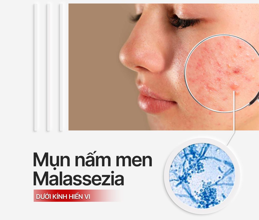 Nhan biet mun nam men Malassezia duoi kinh hien vi